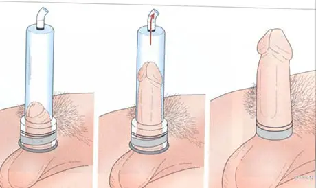 Bombas de Vacio Masculinas: Aumenta tu Confianza y Rendimiento 2 Bombas de Vacio Masculinas: Aumenta tu Confianza y Rendimiento - Oveja Negra Boutique -